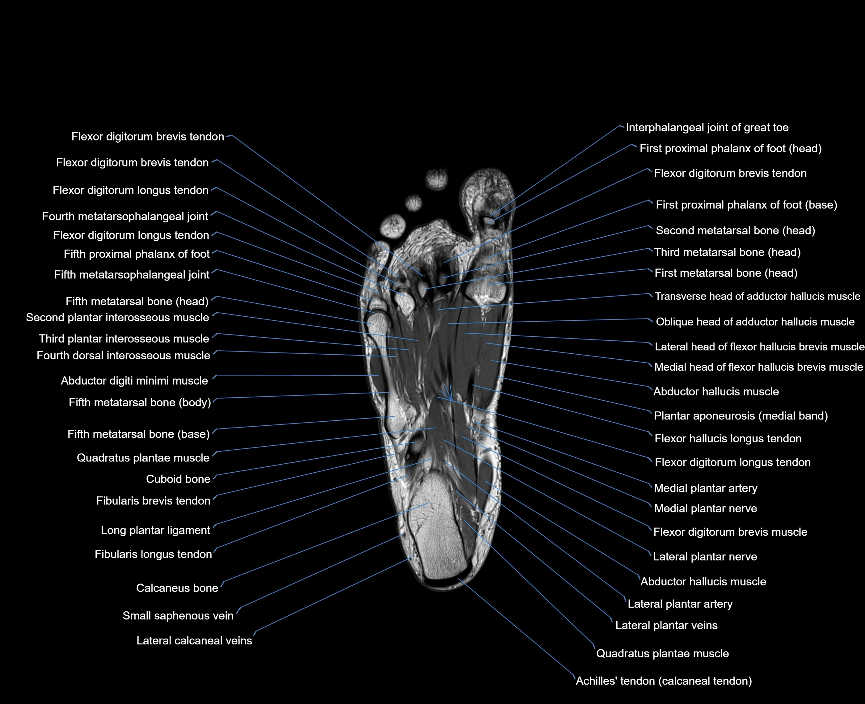 MRI foot coronal cross sectional anatomy 3T  radiology  image-img-00001-00025.webp